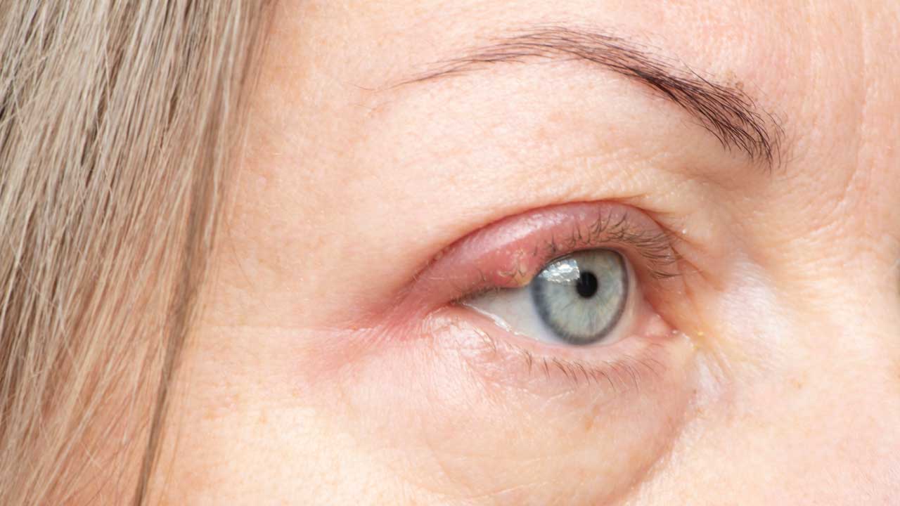 Oculoplastic surgeon examining a patient’s eyelid for chalazion and stye treatment