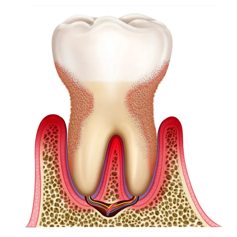 Gum Disease image