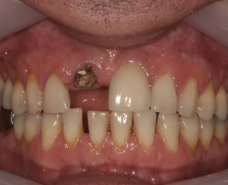 Before Dental Implants