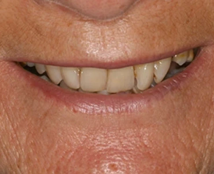 Veneer