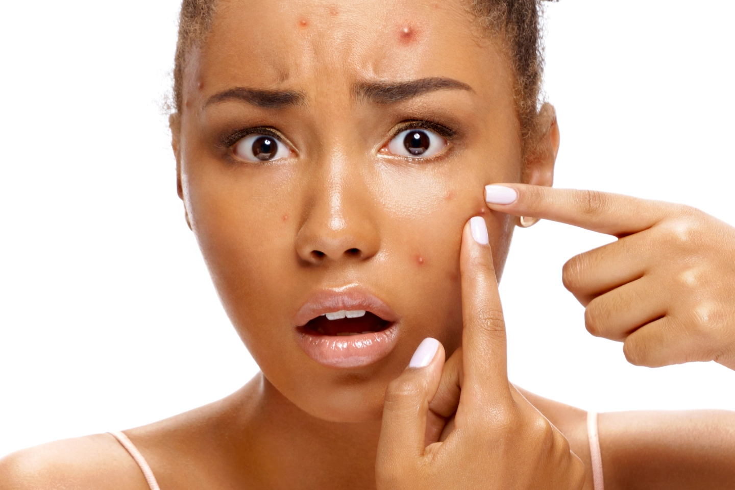Acne is caused by clogged pores, pimples, blackheads.