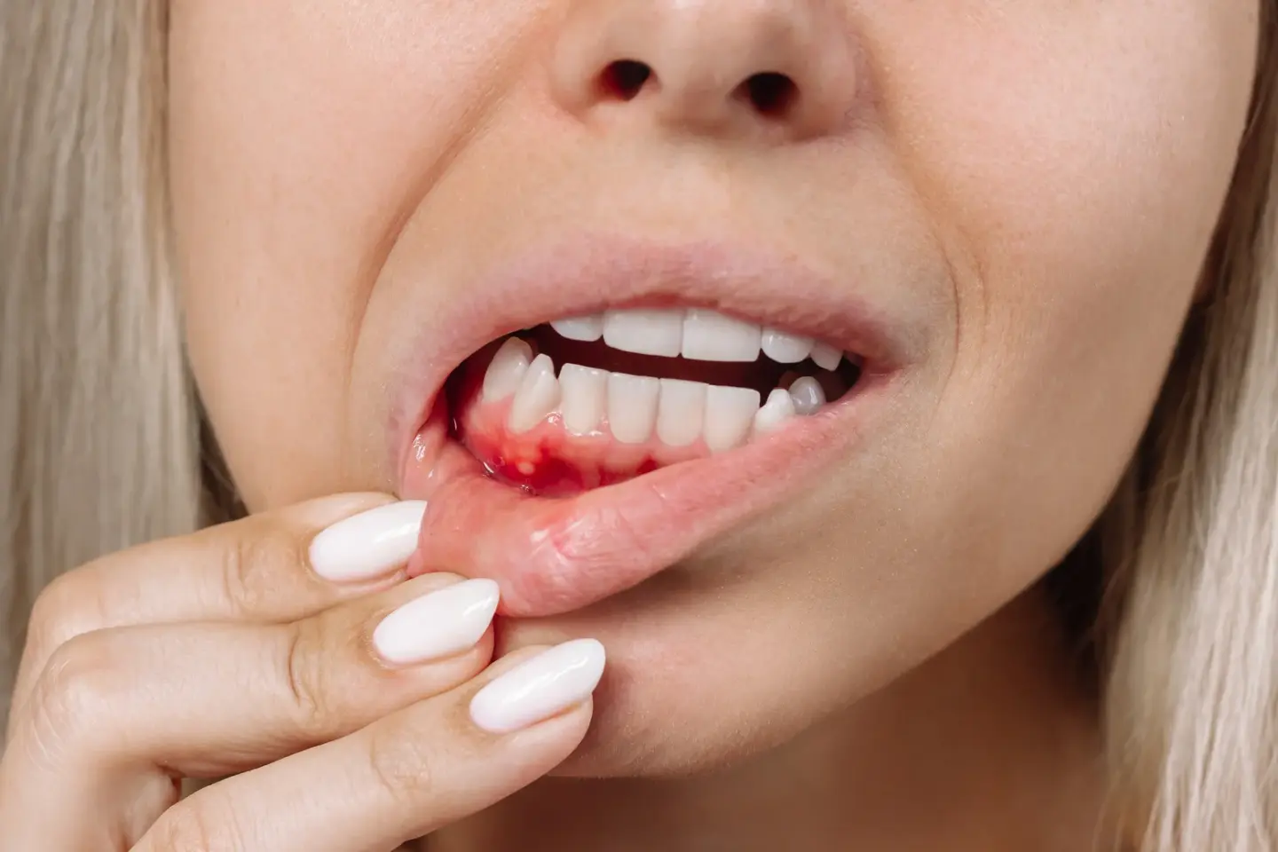  Gum Disease