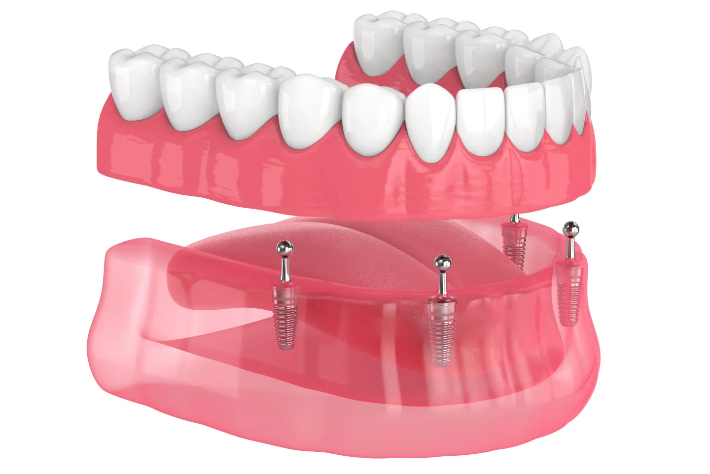 Your Guide to Different Kinds of Dental Implants