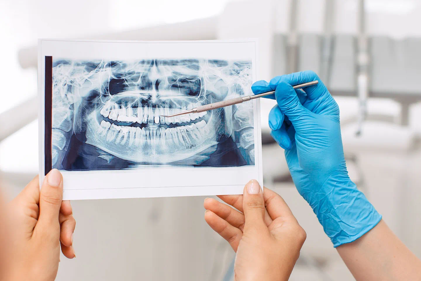Why All-on-4 Implants Are a Top Full-Arch Solution