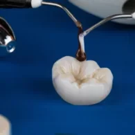 Are CEREC Crowns Better Than Traditional Crowns?