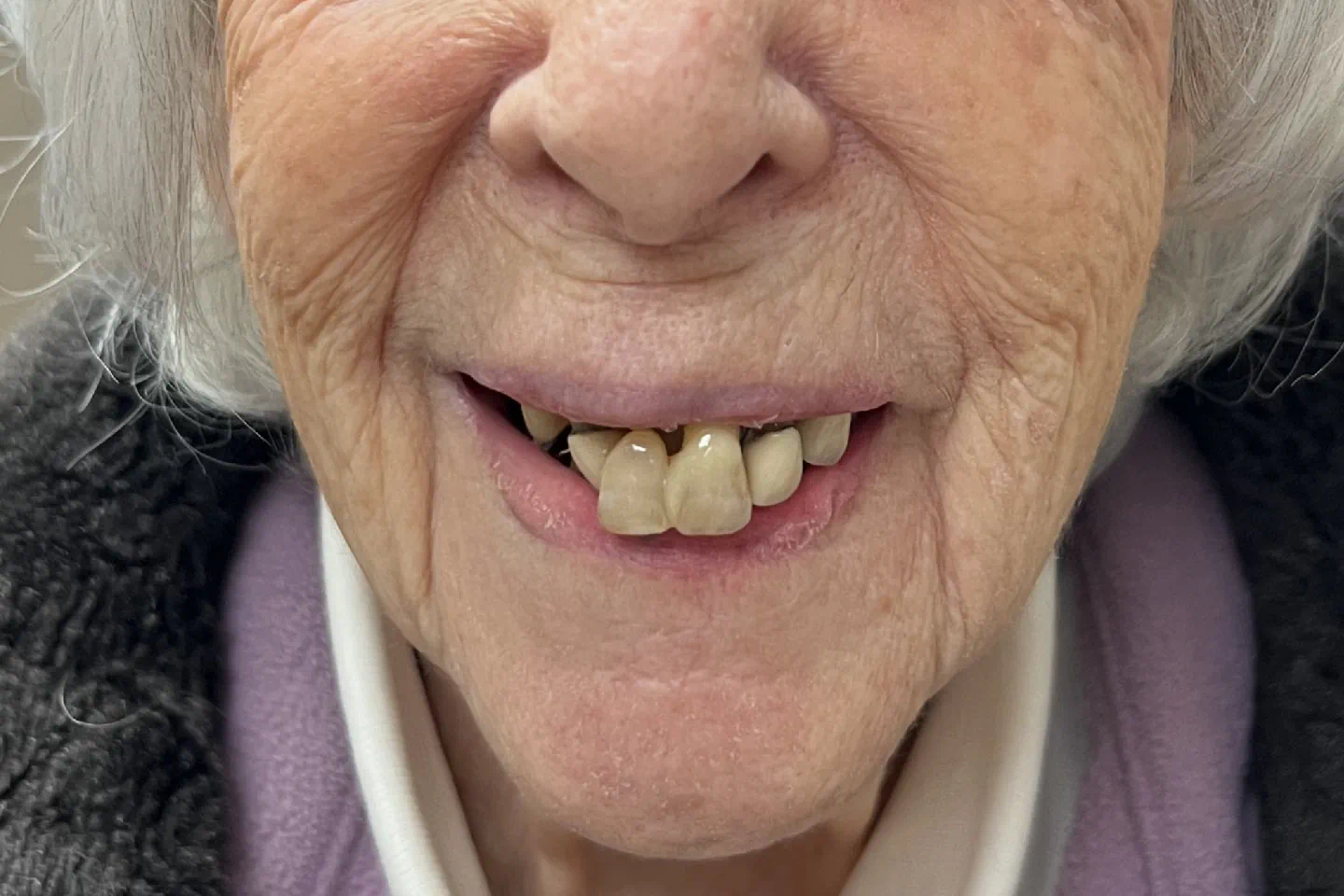 Before denture treatment
