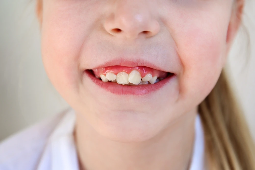 Crooked Teeth