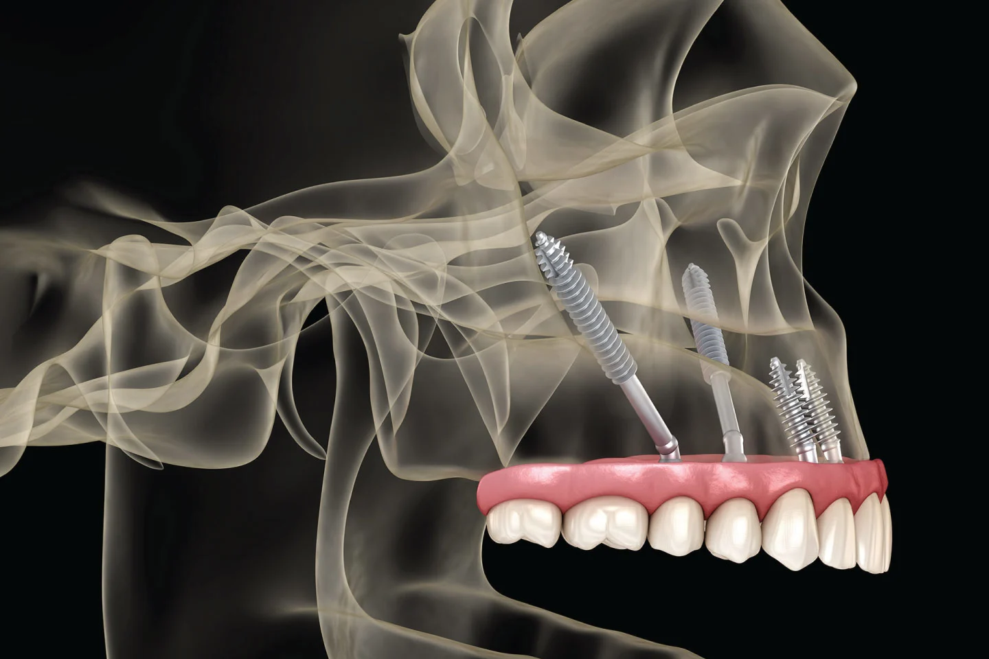 Advanced graftless implant planning and posterior maxillary support