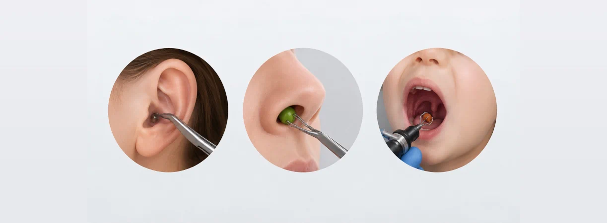 Foreign Body Removal from Ear, Nose and Airway