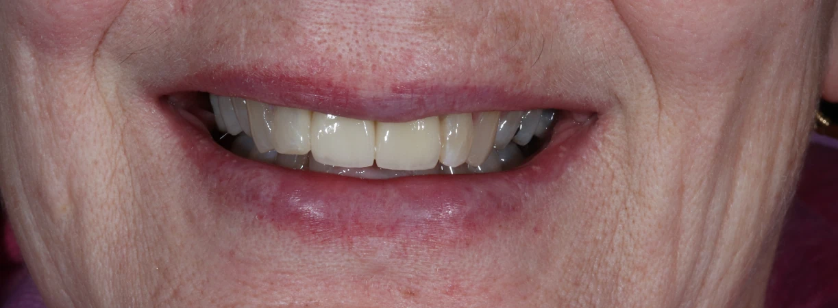 Dental Implants