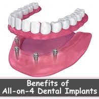 Amazing Benefits of All-On-4 Dental Implants