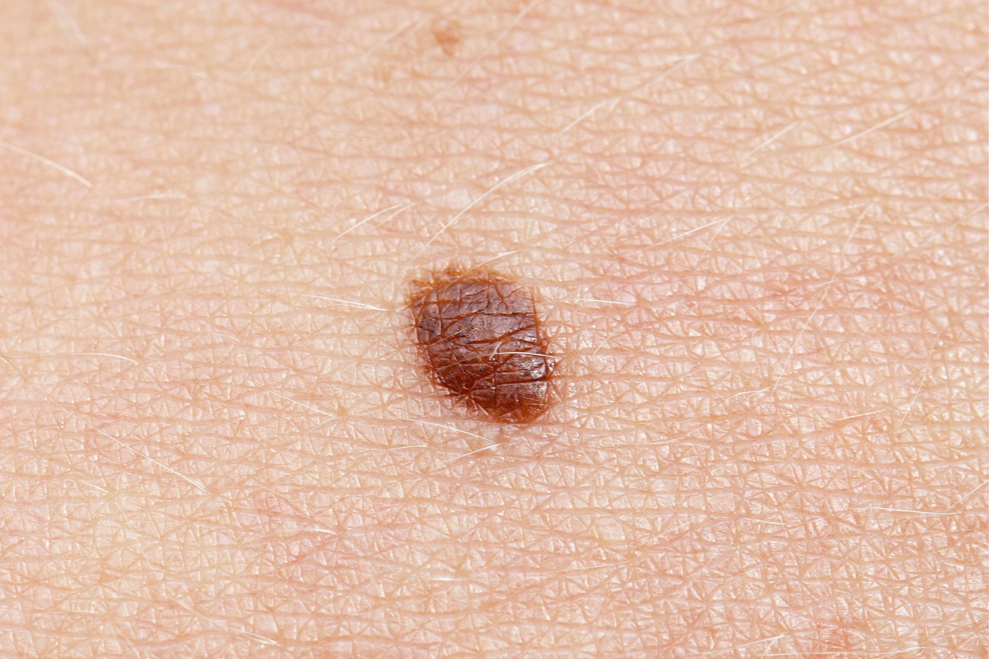 Basal Cell Carcinoma: Early Signs & Treatment Options