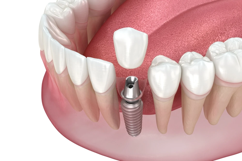 Dental Implants