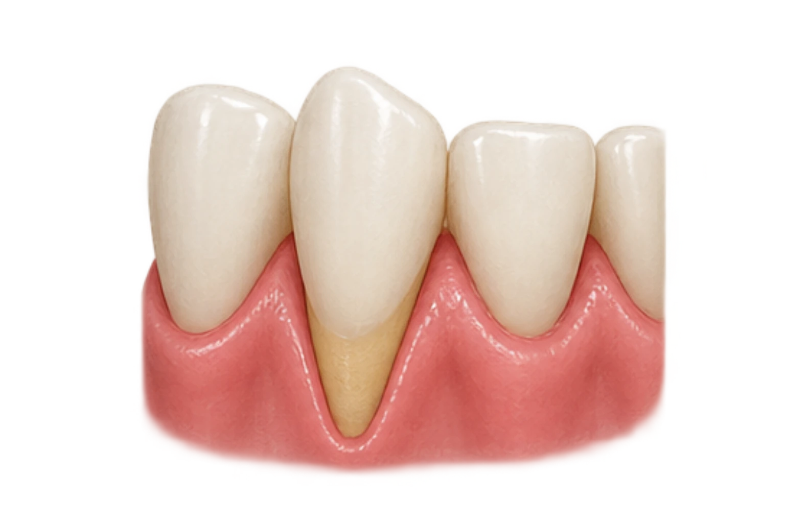 gum recession causes