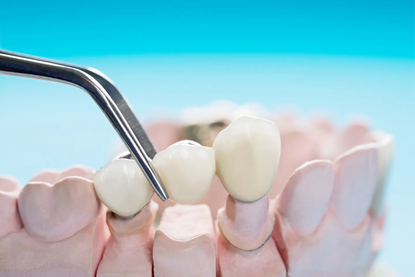 Should You Fix Your Teeth with a Dental Crown or a Dental Bridge?