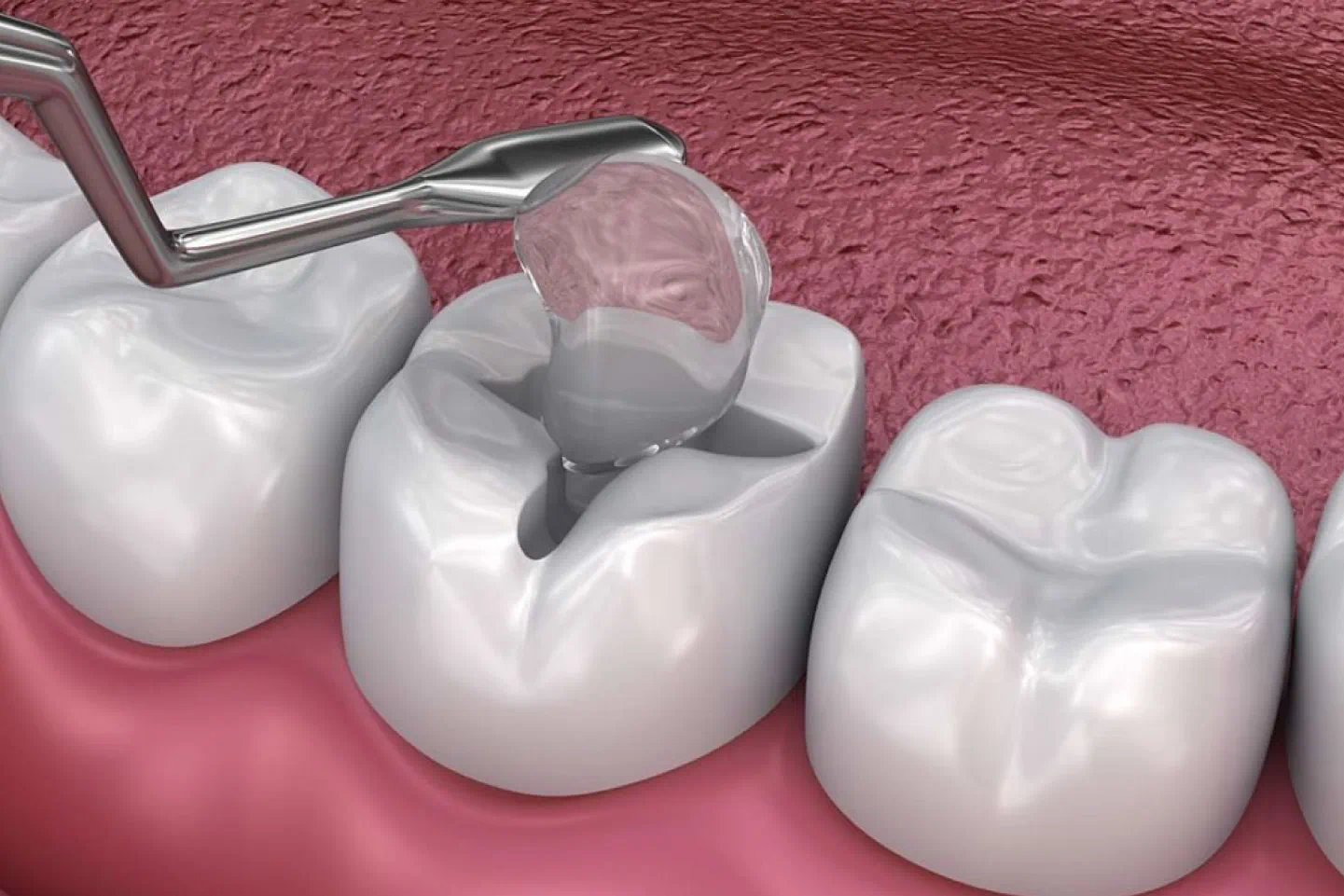 Dental Fillings