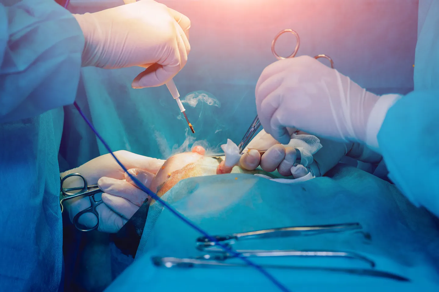 Giant Fibroadenoma Excision