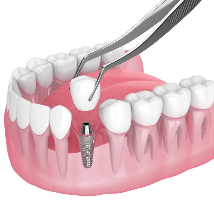 What is the Cost of All-on-4 Dental Implants?