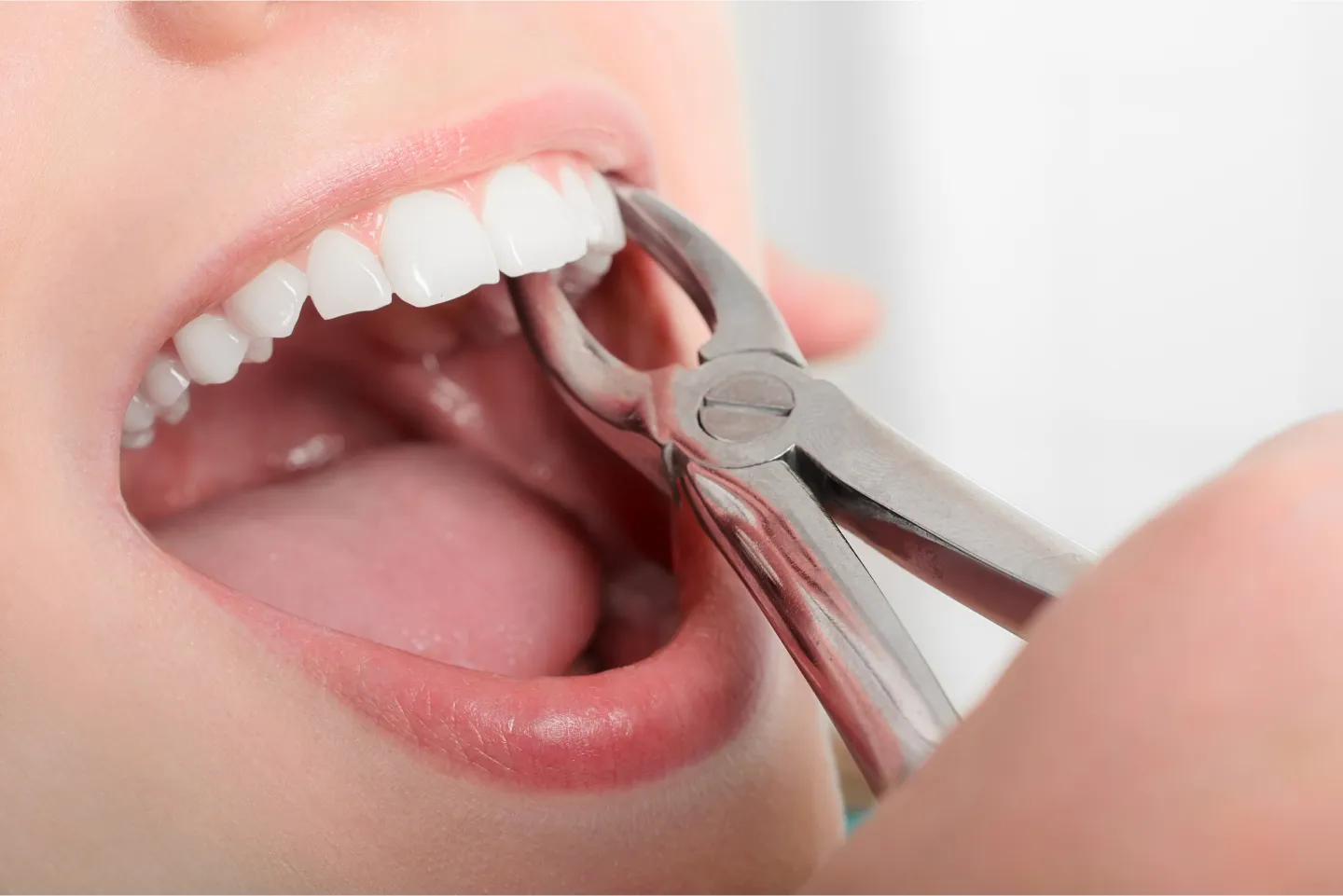 Do You Need a Tooth Extraction | Schaumburg, IL | Dr. Patel