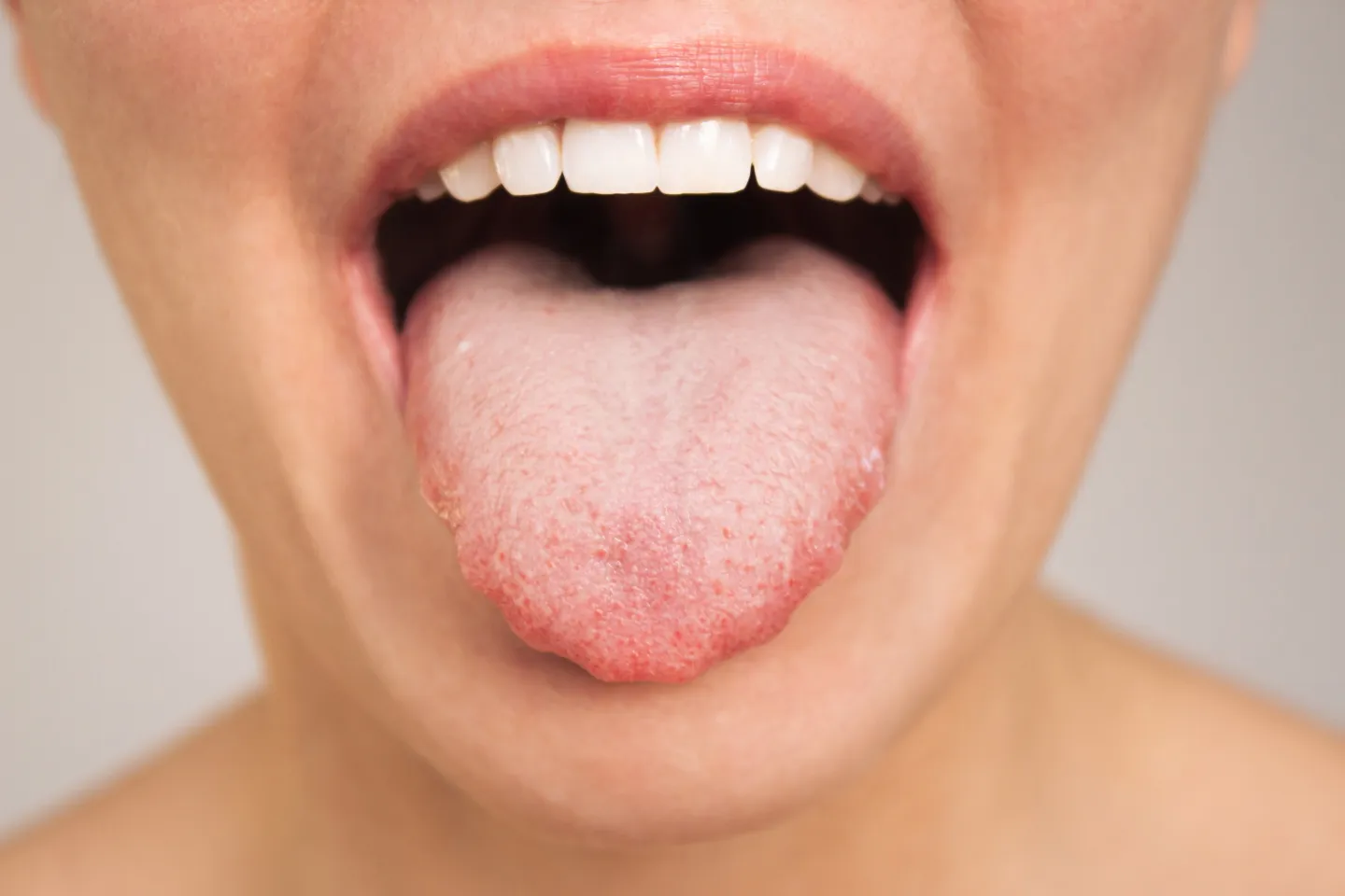 What to know about glossitis -Add Smile Dentistry