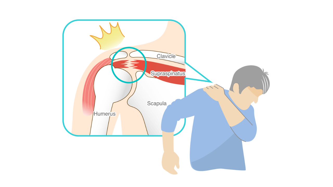 Rotator Cuff Tears: When Surgery Becomes Necessary