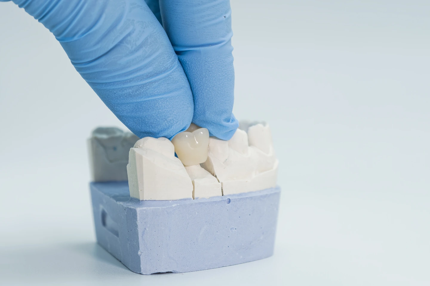 Benefits of Ceramic Crowns for Natural-Looking Smiles