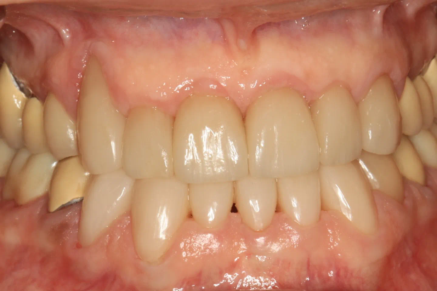 After aesthetic crown treatment