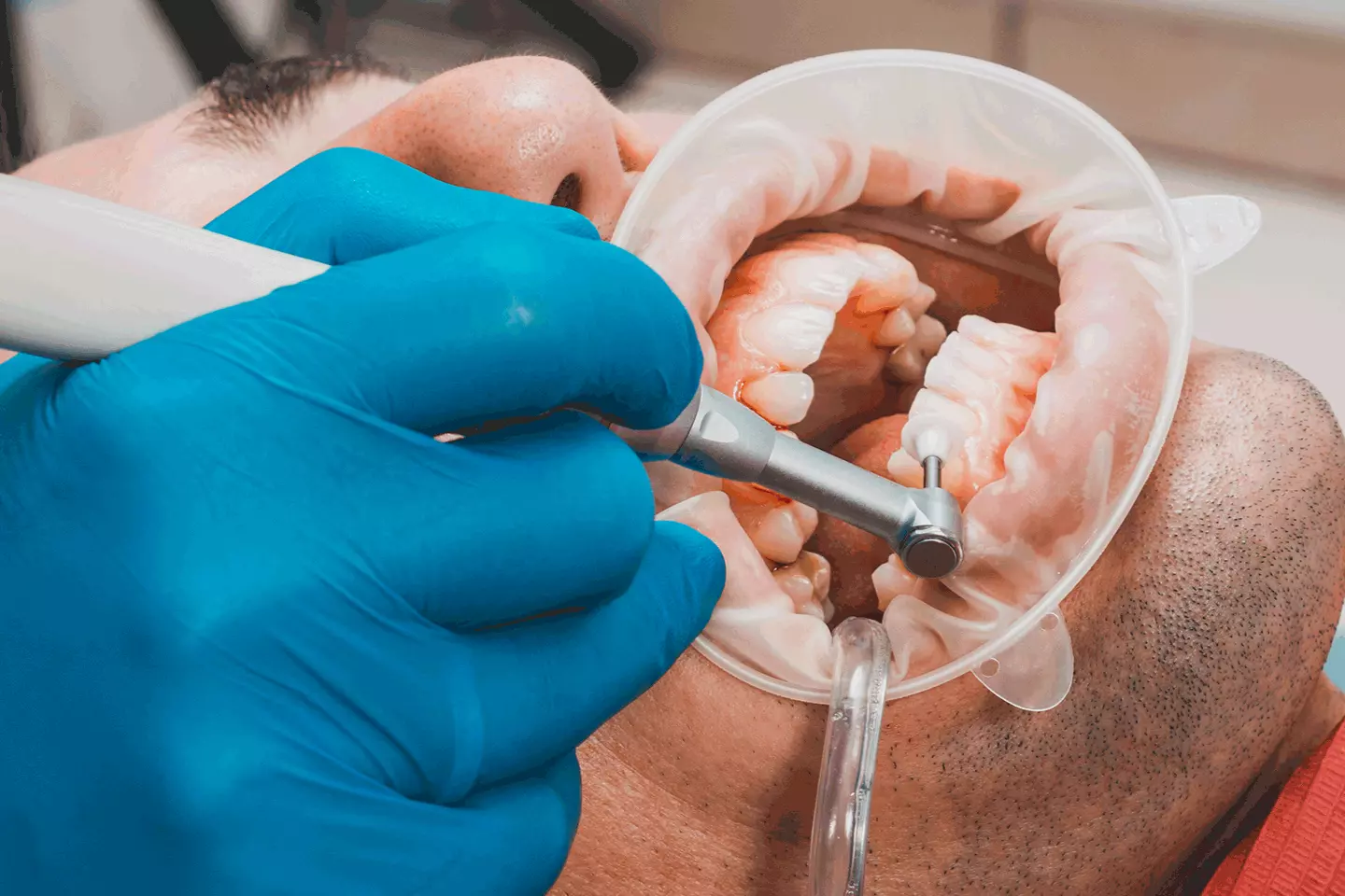 Plaque vs Tartar: What is the Difference and Why Does It Matter?