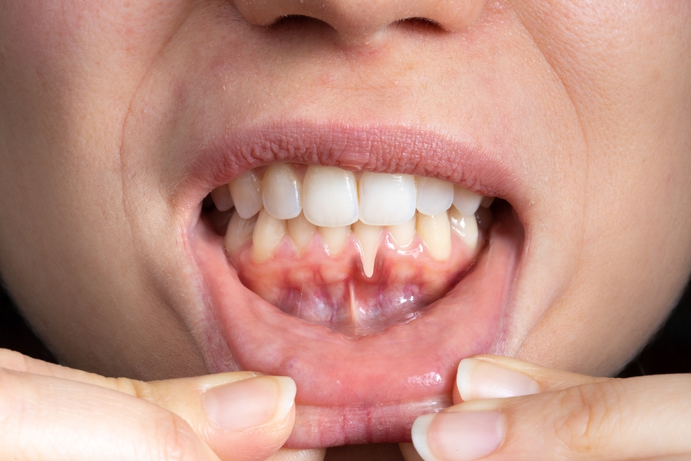 Receding Gums: Causes, Treatments & Prevention | Parkway Smiles Dentistry