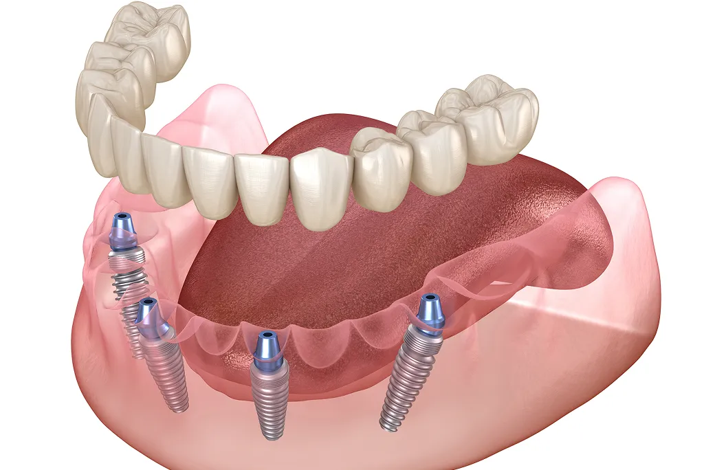 All-on-X Full Mouth Dental Implants