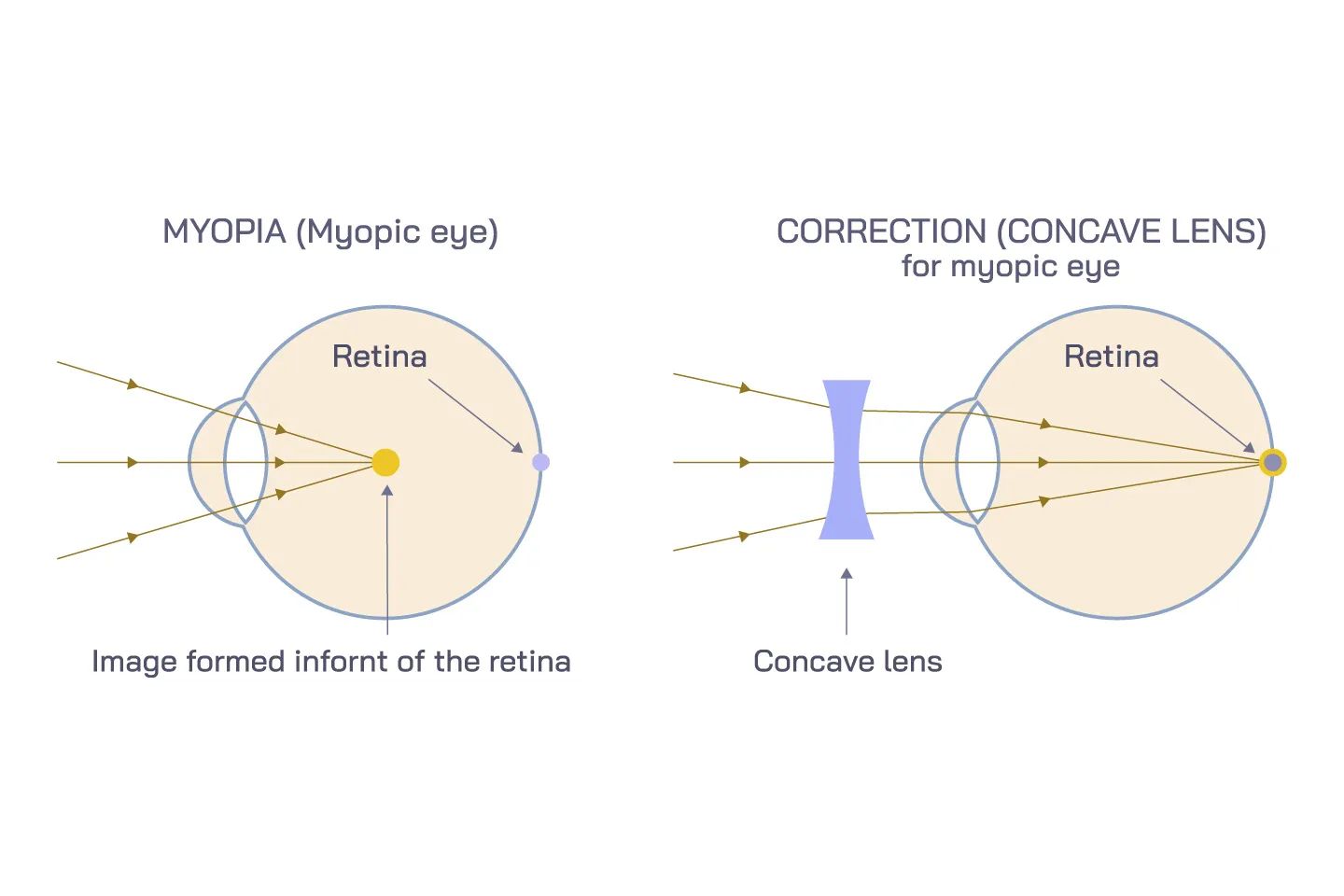 Is Myopia Management Worth the Investment?
