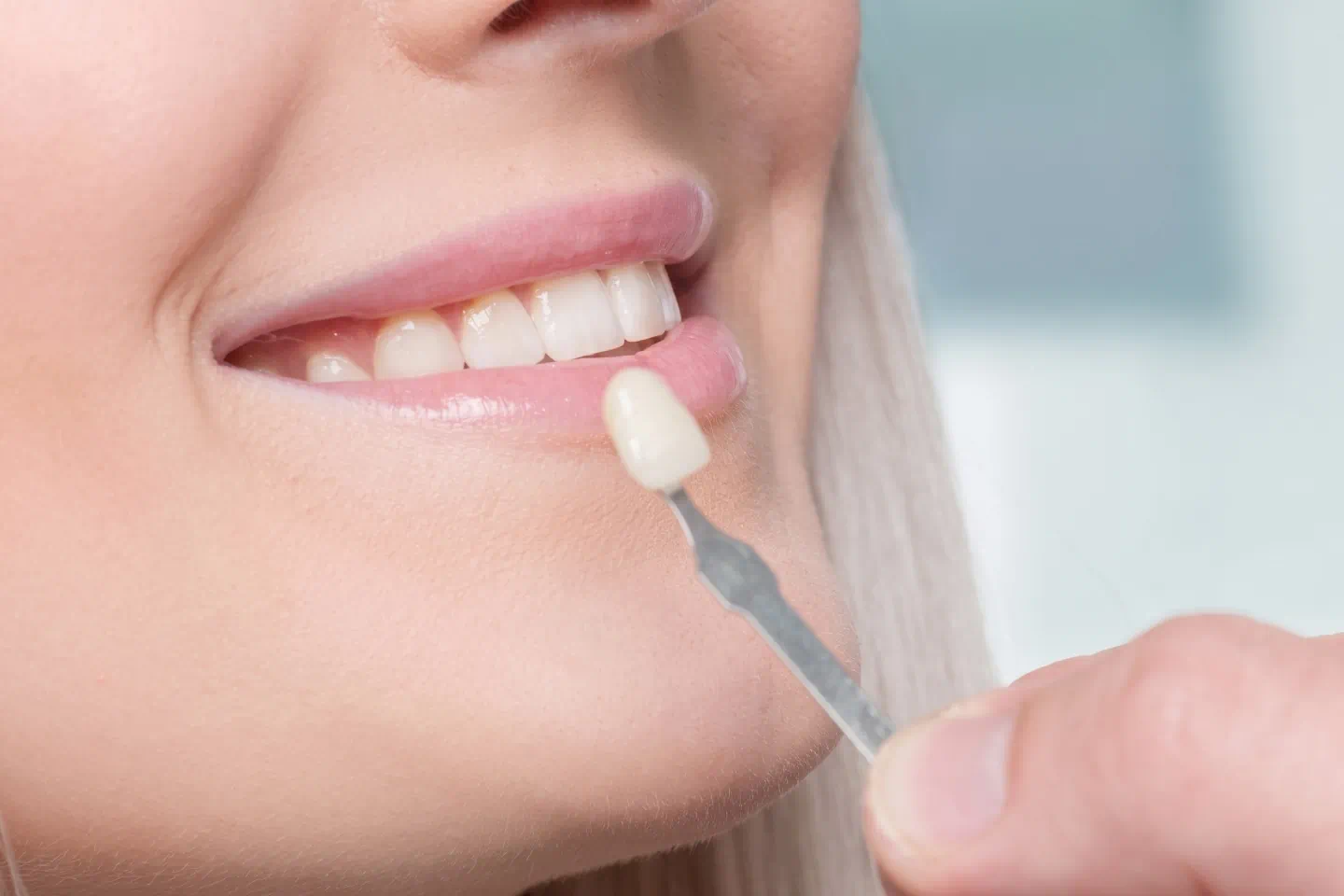 Veneers