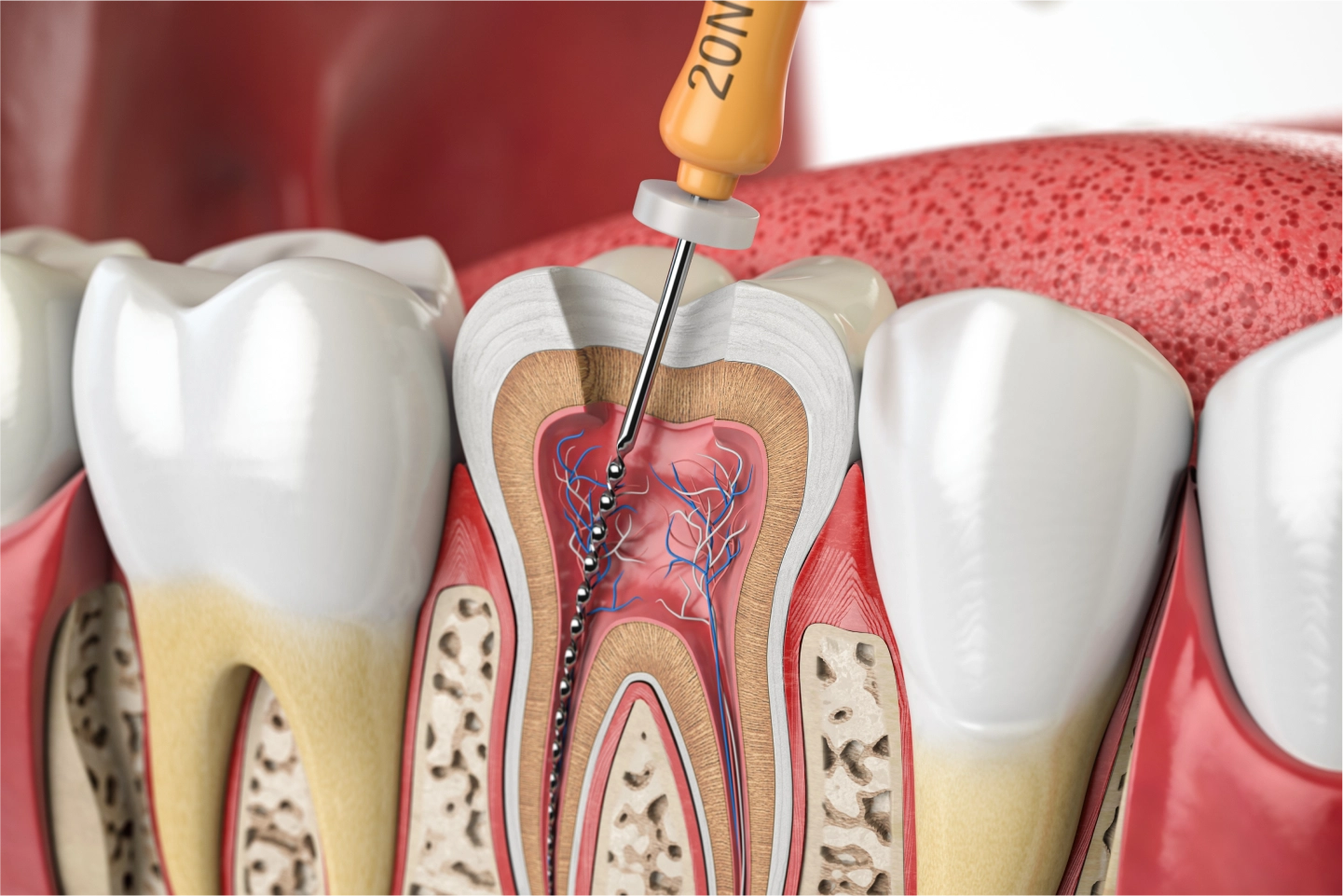 Root canal treatment at Glendale Heights Family Dental