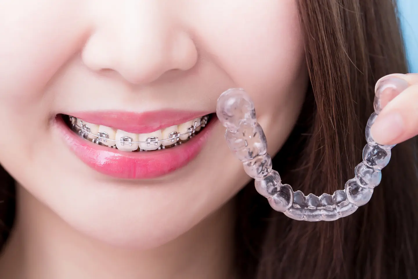 What Braces Can Do for Your Smile