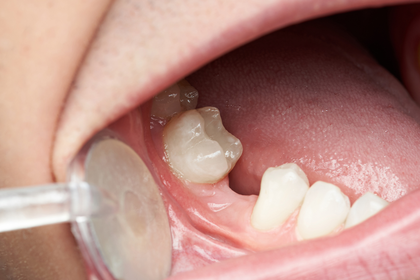 Adult closing a noticeable gap in smile before tooth replacement at Family Dental of Georgetown