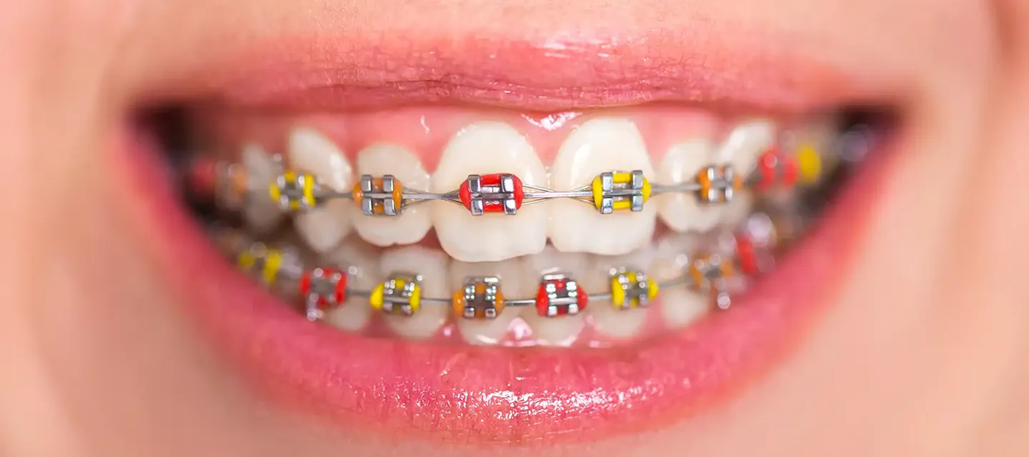 Is DIY Orthodontia Truly a Bargain