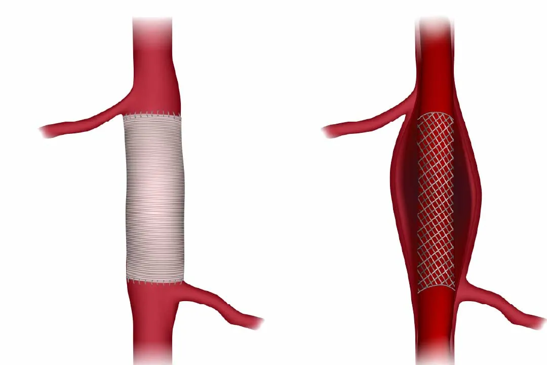 Aortic Aneurysm Repair