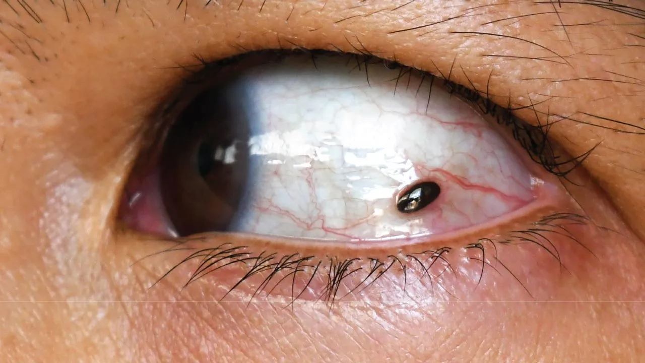 ocular tumor eye anatomy diagram
