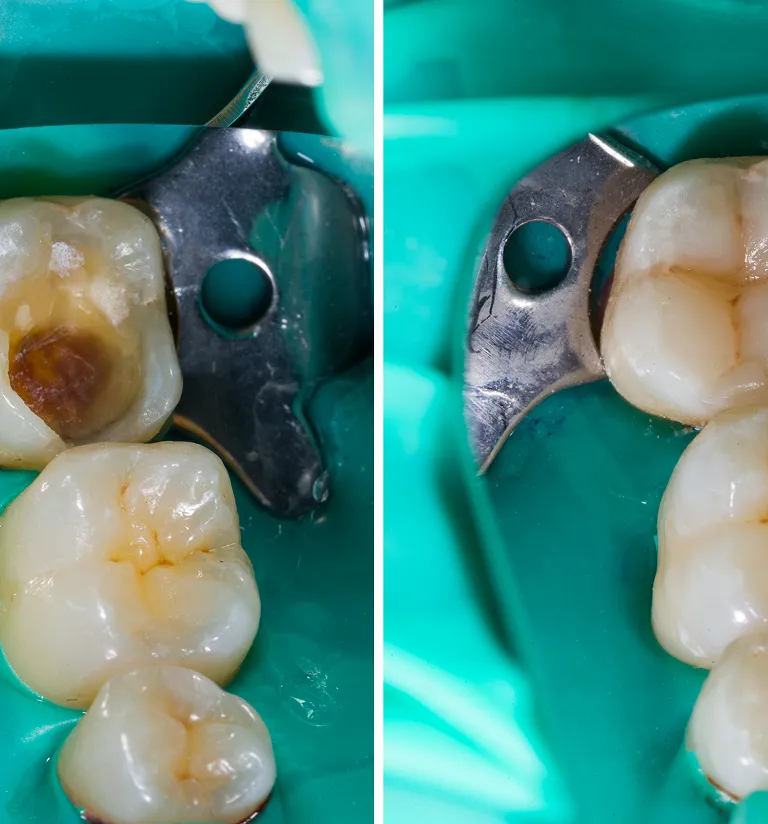 Why See Royal Dental Care For Dental Implants?