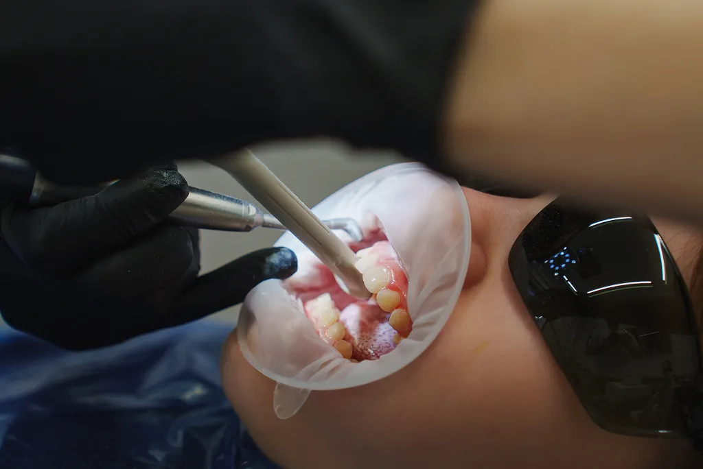 Root Canal Treatment Illustration