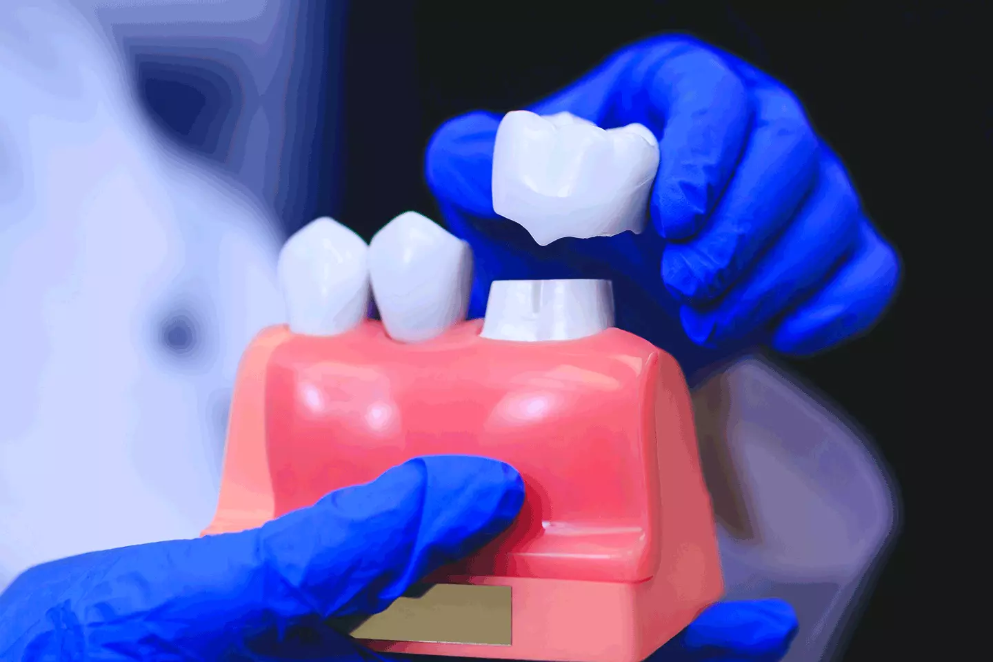 Damaged Tooth Repair With a Dental Crown