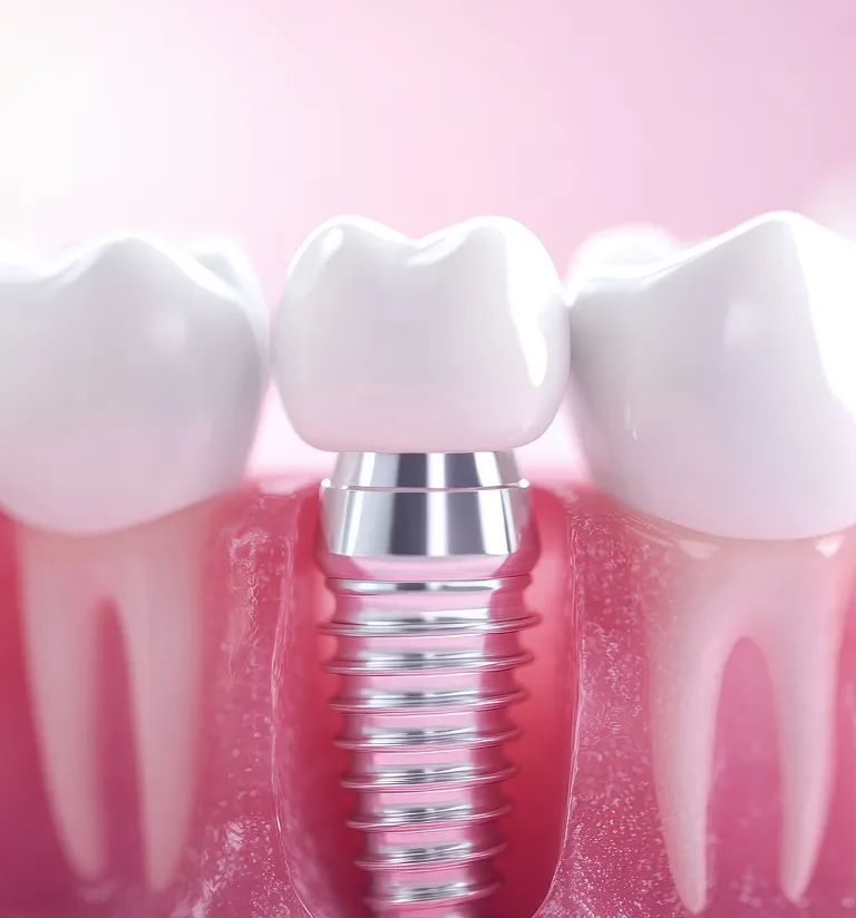 Can a Tooth Root Be Removed to Get a Dental Implant?
