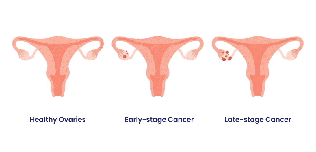 Early Signs of Ovarian Cancer