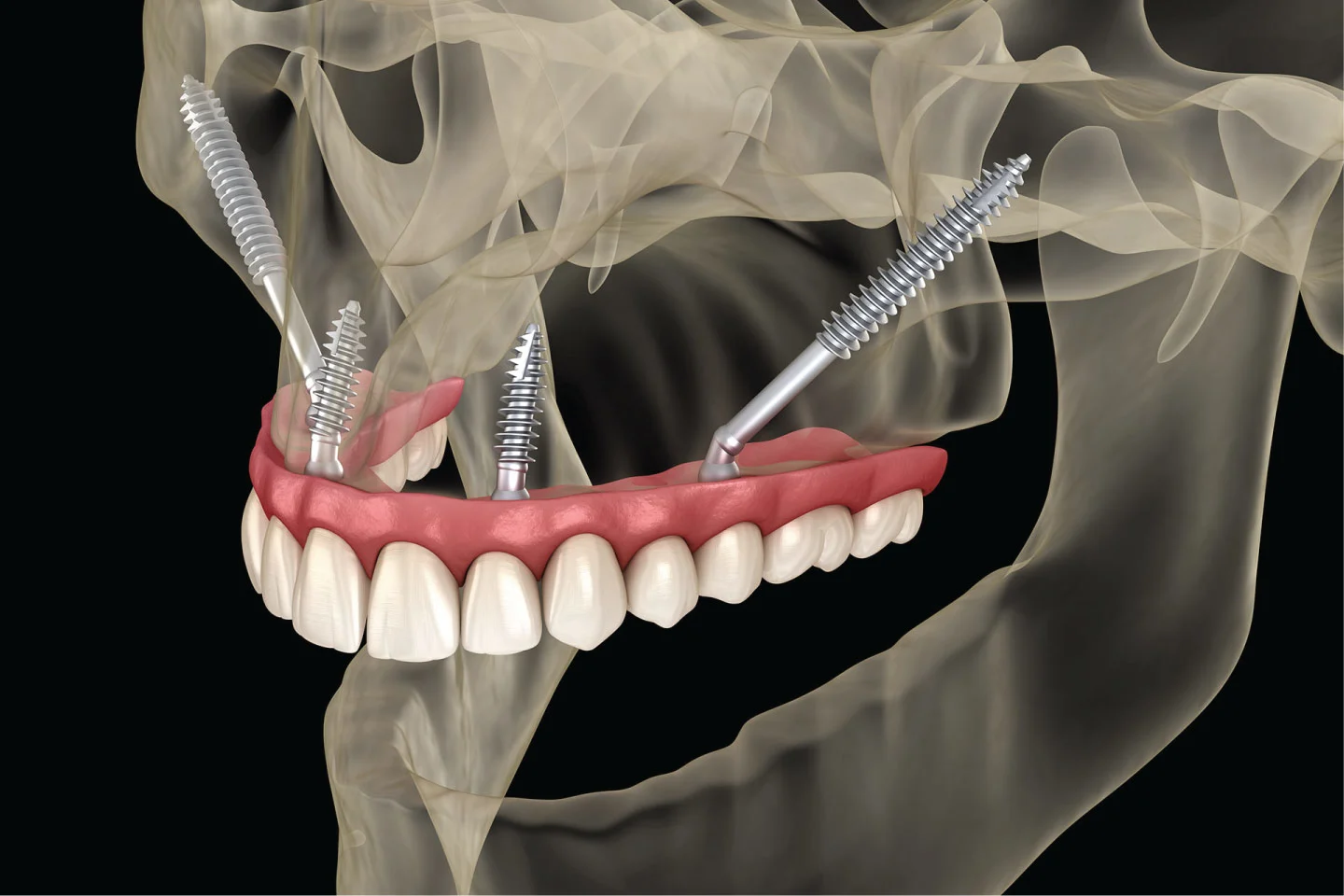 Advanced implantology using zygomatic pterygoid and transnasal implants