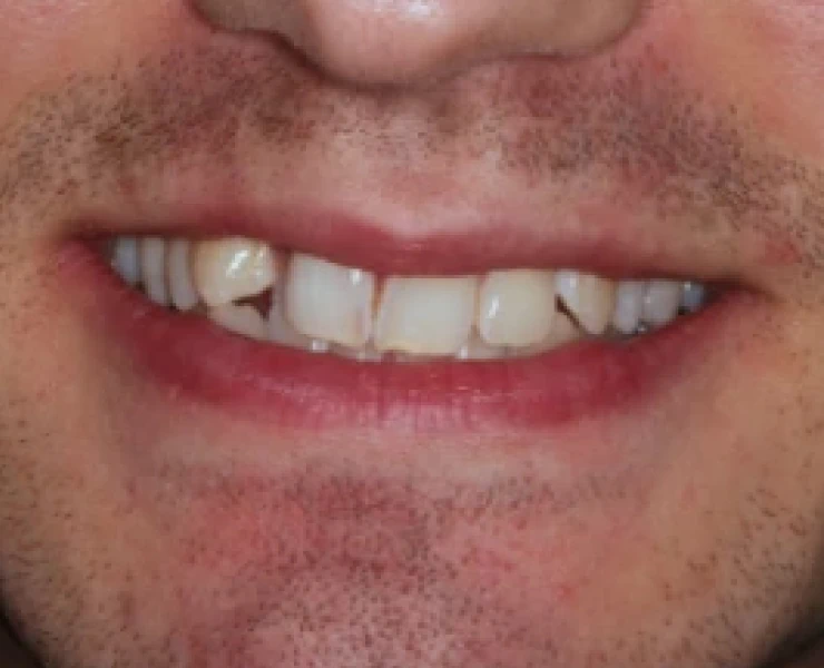 Invisalign Case 1
