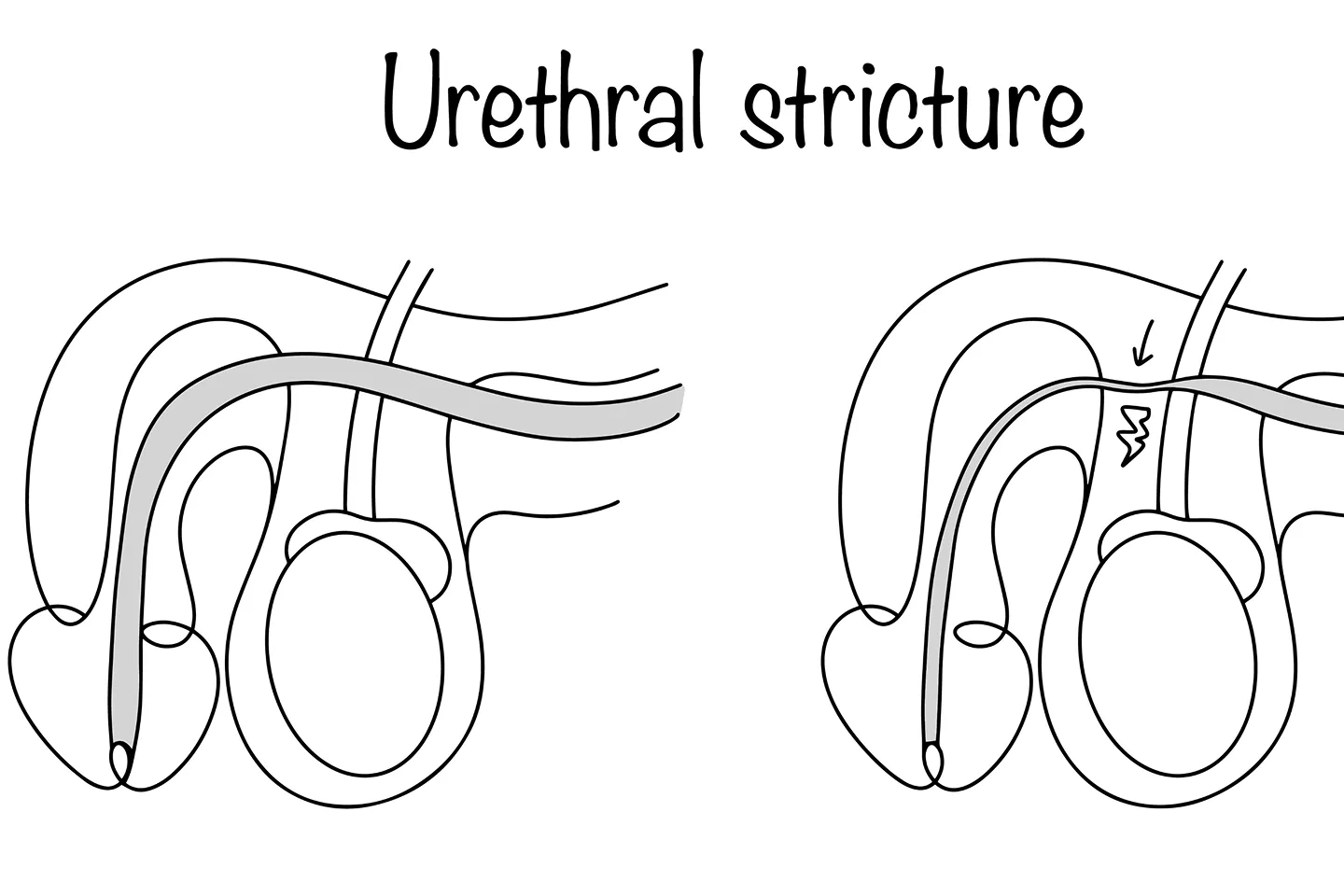 Urethral Stricture: Causes, Symptoms, and Advances in Treatment