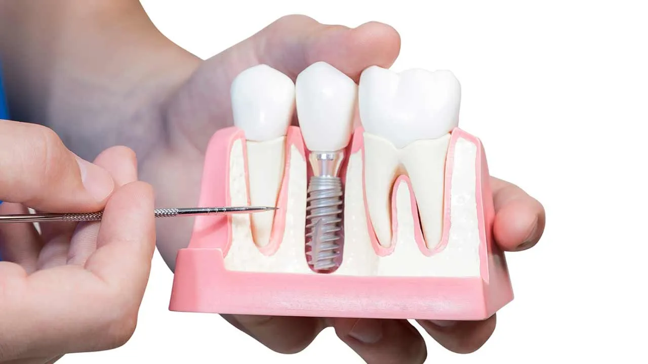 Dental Implant Restorations: Gen Z Dentistry