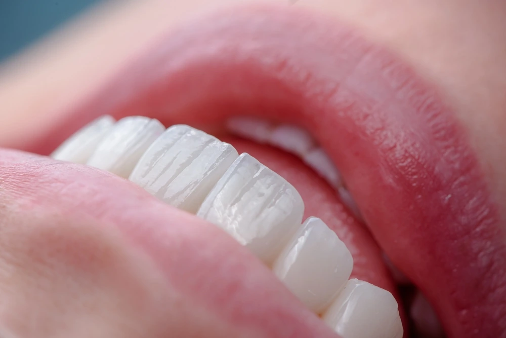 Porcelain Veneers in Bloomingdale, IL
