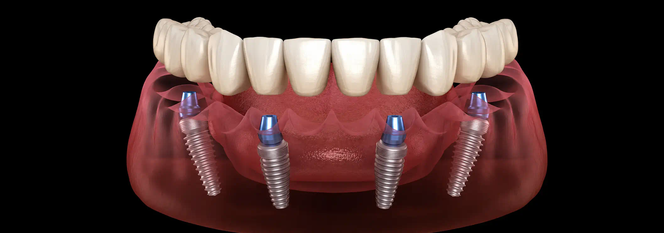All-on-4® Dental Implants