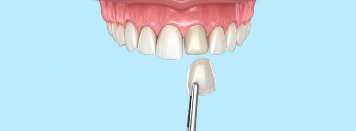 Veneers